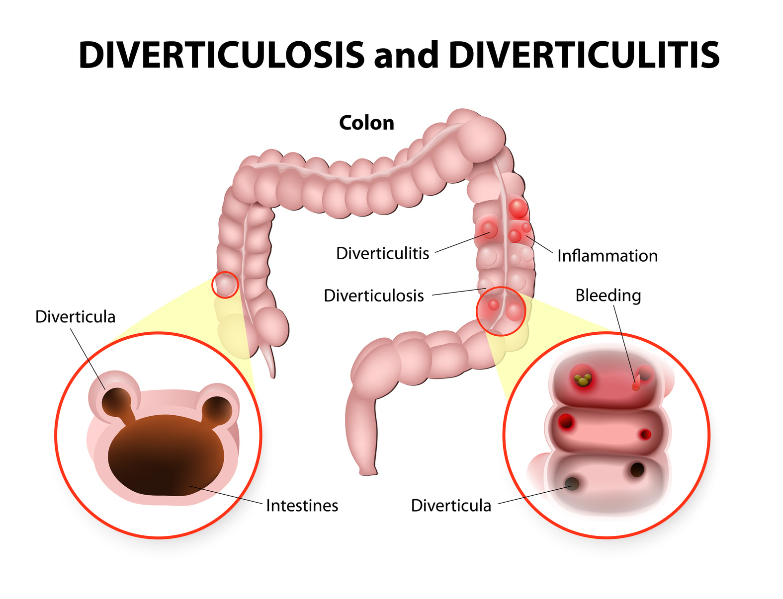 Divertículos en el intestino delgado Divertículos en el intestino delgado