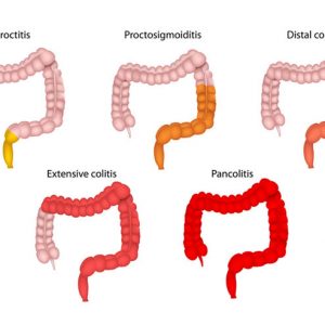Ulcerative Colitis