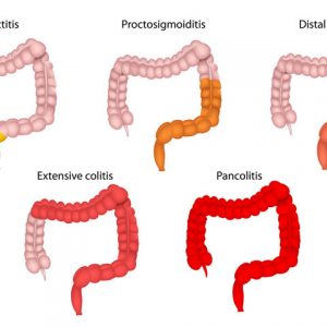 Ulcerative colitis